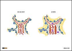 ilustracja medyczna, naukowa, anatomiczna - obraz histopatologiczny komórek płuc